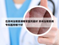 在郑州治银屑病哪家医院最好 郑州治银屑病专科医院哪个好