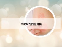 牛皮癣伤口愈合慢