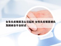 女生头皮银屑怎么引起的 女性头皮银屑病头发剃掉会不会好点