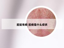 屁腚有癣 屁癣是什么症状