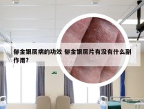 郁金银屑病的功效 郁金银屑片有没有什么副作用?