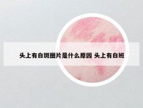 头上有白斑图片是什么原因 头上有白班