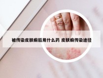 被传染皮肤癣后用什么药 皮肤癣传染途径