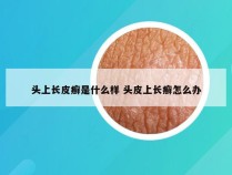 头上长皮癣是什么样 头皮上长癣怎么办