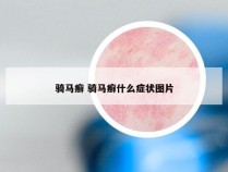 骑马癣 骑马癣什么症状图片