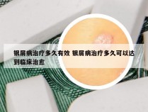 银屑病治疗多久有效 银屑病治疗多久可以达到临床治愈