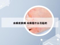 水癣皮肤病 水癣是什么引起的