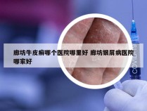 廊坊牛皮癣哪个医院哪里好 廊坊银屑病医院哪家好