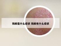 钱癣是什么症状 钱癣有什么症状