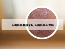 头癣影响要孩子吗 头癣影响头发吗