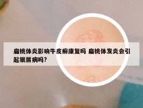 扁桃体炎影响牛皮癣康复吗 扁桃体发炎会引起银屑病吗?