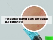 小斑块副银屑病斑块能消退吗 斑块状副银屑病与银屑病的区别