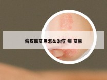 癣皮肤变黑怎么治疗 癣 变黑