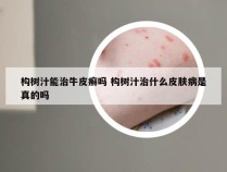 构树汁能治牛皮癣吗 构树汁治什么皮肤病是真的吗