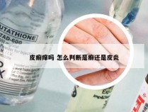 皮癣痒吗 怎么判断是癣还是皮炎