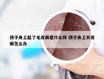 孩子身上起了毛皮癣是什么样 孩子身上长皮癣怎么办