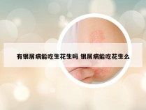 有银屑病能吃生花生吗 银屑病能吃花生么