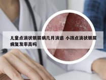 儿童点滴状银屑病几月消退 小孩点滴状银屑病复发率高吗