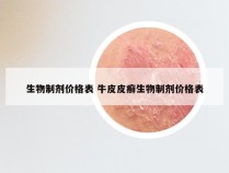 生物制剂价格表 牛皮皮癣生物制剂价格表