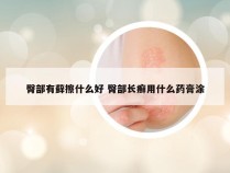 臀部有藓擦什么好 臀部长癣用什么药膏涂