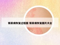 银屑病恢复过程图 银屑病恢复图片大全