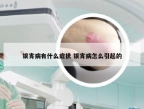 银宵病有什么症状 银宵病怎么引起的