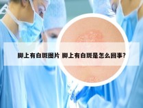 脚上有白斑图片 脚上有白斑是怎么回事?