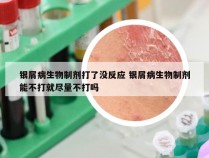 银屑病生物制剂打了没反应 银屑病生物制剂能不打就尽量不打吗