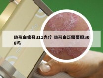 隐形白癜风311光疗 隐形白斑需要照308吗