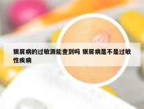 银屑病的过敏源能查到吗 银屑病是不是过敏性疾病