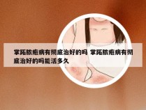 掌跖脓疱病有彻底治好的吗 掌跖脓疱病有彻底治好的吗能活多久