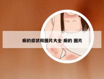 癣的症状和图片大全 癣的 图片