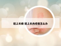 胫上长癣 胫上长肉疙瘩怎么办