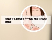 桂枝汤合小柴胡汤治疗牛皮癣 柴胡桂枝汤治银屑病