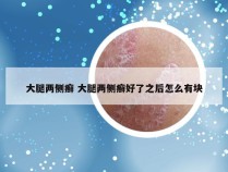 大腿两侧癣 大腿两侧癣好了之后怎么有块