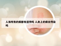 人体所有的癣都有遗传吗 人身上的癣会传染吗