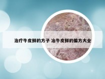 治疗牛皮鲜的方子 冶牛皮鲜的偏方大全