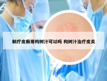 制疗皮癣用构树汁可以吗 构树汁治疗皮炎