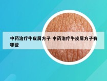 中药治疗牛皮屑方子 中药治疗牛皮屑方子有哪些