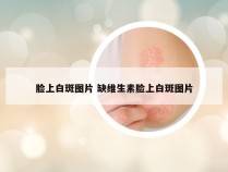 脸上白斑图片 缺维生素脸上白斑图片