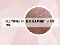 身上长癣打什么针管用 身上长癣打什么针管用呢