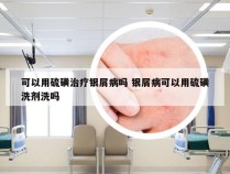 可以用硫磺治疗银屑病吗 银屑病可以用硫磺洗剂洗吗