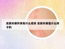 皮肤长癣外表有什么症状 皮肤长癣是什么样子的