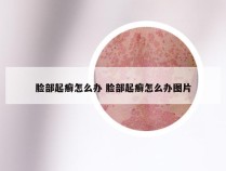 脸部起癣怎么办 脸部起癣怎么办图片