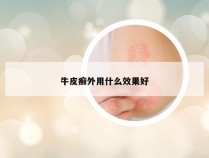 牛皮癣外用什么效果好