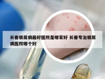 长春银屑病最好医院是哪家好 长春专治银屑病医院哪个好