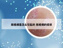 脓疱病是怎么引起的 脓疱病的症状