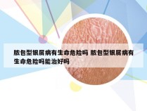 脓包型银屑病有生命危险吗 脓包型银屑病有生命危险吗能治好吗