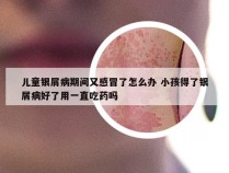 儿童银屑病期间又感冒了怎么办 小孩得了银屑病好了用一直吃药吗