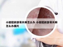 小腿胫前部易长癣怎么办 小腿胫前部易长癣怎么办图片